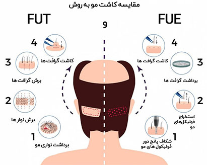 مقایسه FUT و FUE