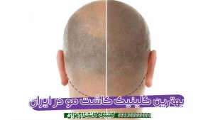بهترین کلینیک کاشت مو در ایران