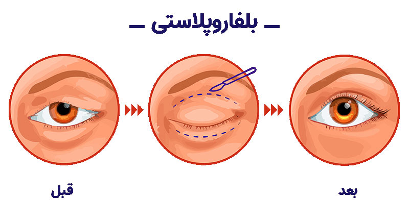 انجام عمل بلفاروپلاستی