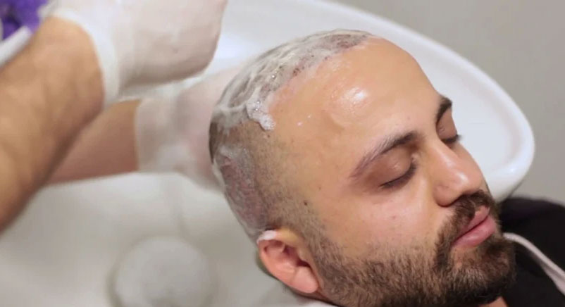 شستشوی مو پس از کاشت مو