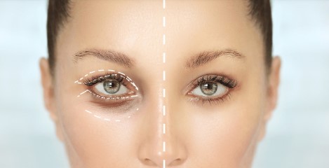 تفاوت بلفاروپلاستی زیبایی و درمانی