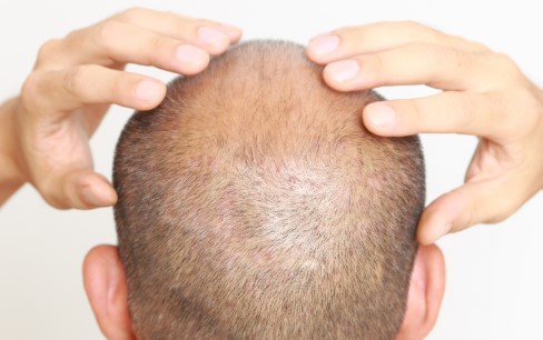 دلیل بی‌حسی کف سر پس از کاشت مو چیست؟
