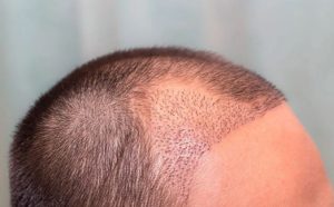 علت نازک شدن مو بعد از کاشت مو