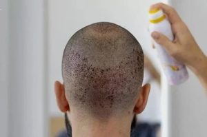 اسپری آبرسان تقویتی بعد از کاشت مو