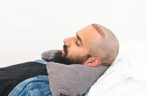 نقش خواب کافی در بهبود نتایج کاشت مو