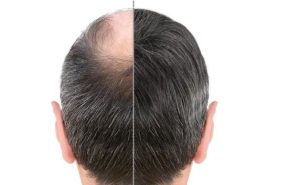 آیا کاشت مو به عنوان یک سرمایه‌گذاری دائمی محسوب می‌شود؟؟