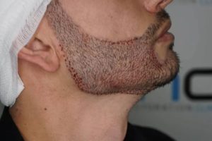 علت ناصافی یا کچلی‌های کوچک بعد از کاشت ریش