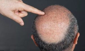 کاشت مو با بانک موی ضعیف انجام می‌شود