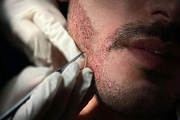 چرا ریش‌های کاشته‌شده در برخی افراد کم‌پشت می‌مانند؟