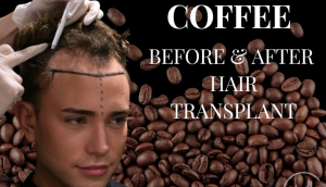 تأثیر مصرف کافئین بر رشد موهای کاشته‌شده