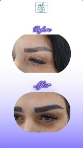 نمونه کار کاشت ابرو نوین همسا